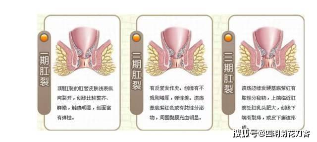 肛裂的症状正常图片