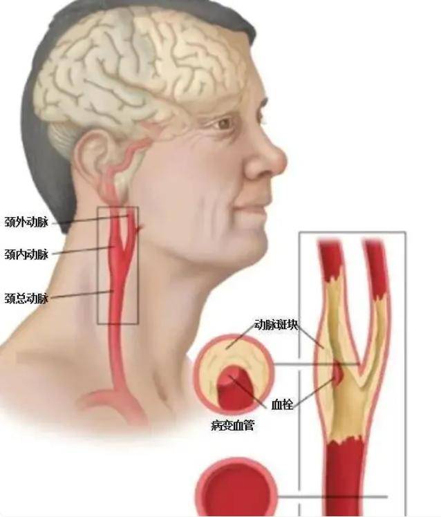 颈总动脉位置真人图片图片