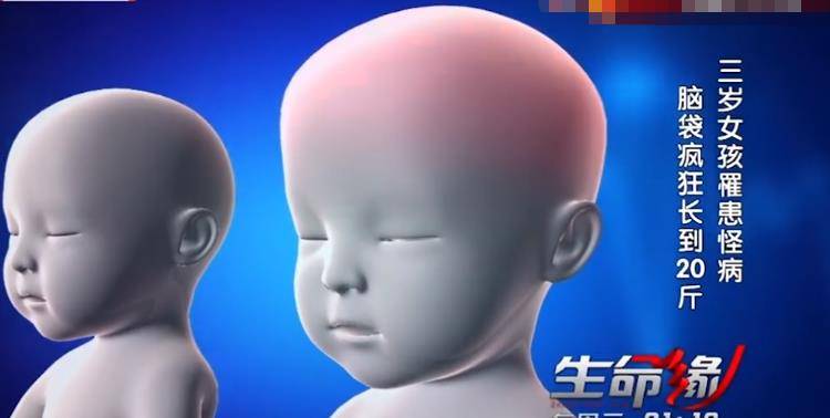 但是涵涵却无法无法自然吸收,就这样积水在涵涵脑袋