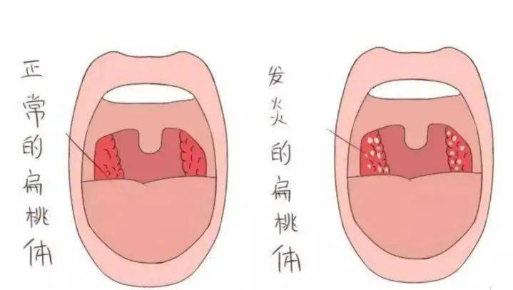 扁桃体,作为咽喉中的一个核心免疫器官,扮演着抵御外界病原体的第一道
