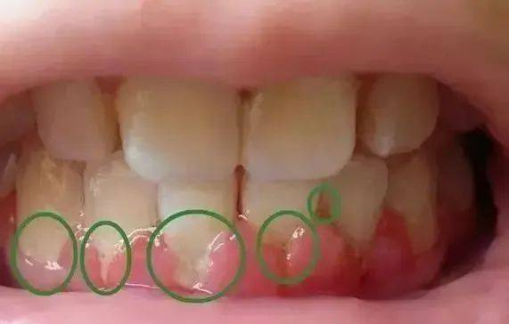 从不洗牙的人牙齿掉的快,为啥?