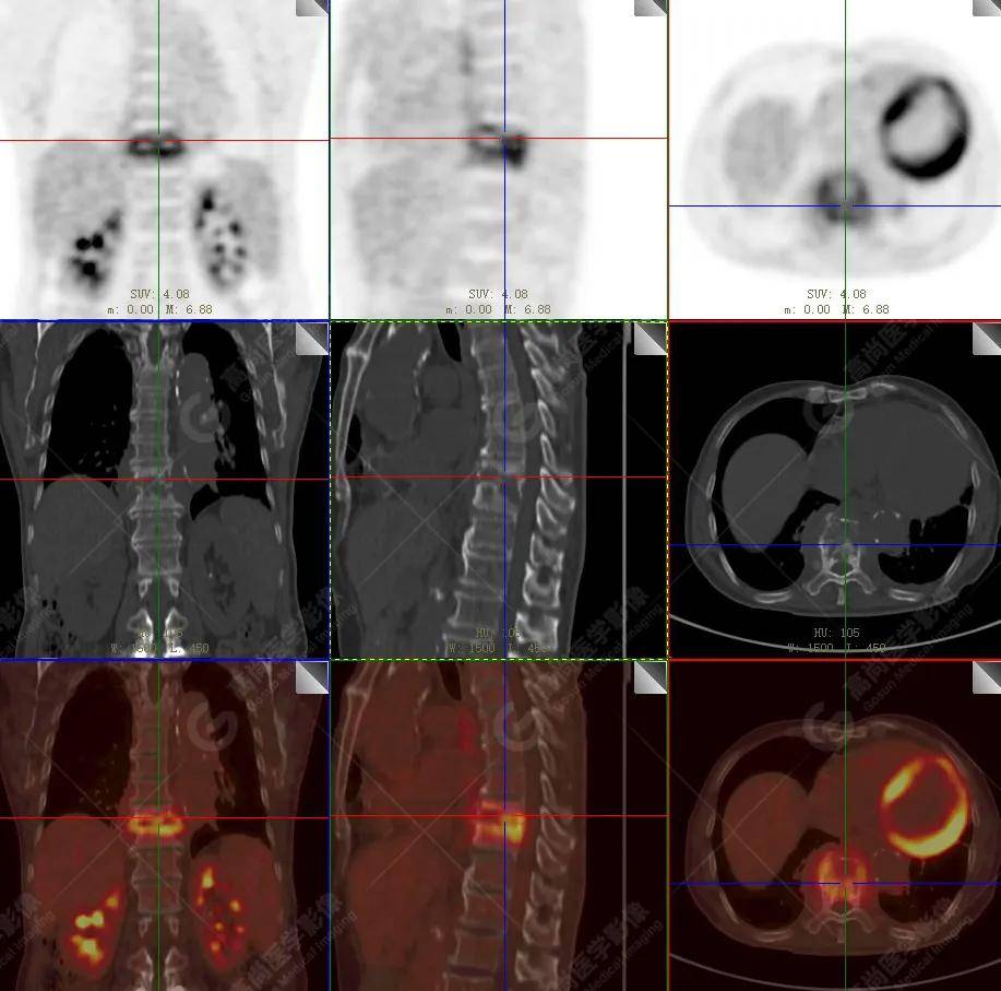 【高尚病例】18f-fdg pet/ct显像应用于骨结核