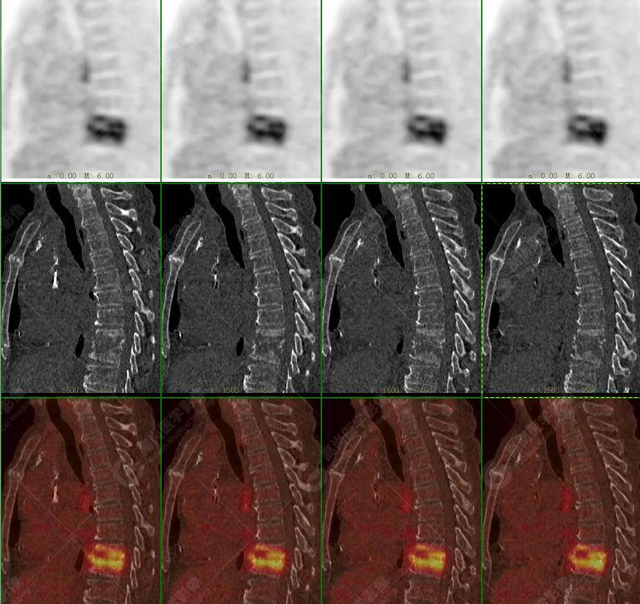 【高尚病例】18f-fdg pet/ct显像应用于骨结核