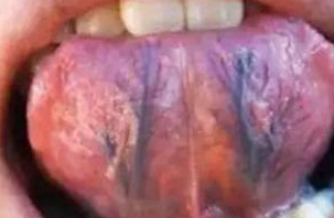 舌下正常人舌底颜色淡红,舌脉淡紫色或淡红,如果身体有淤堵,气血不畅