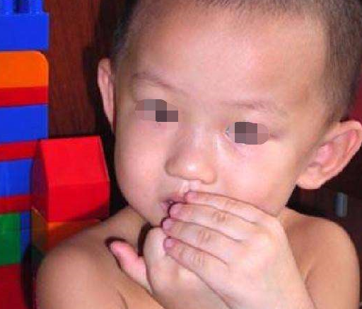 5岁宝宝喜欢啃手指甲，指甲变形外翻。如果他被医生诊断为异食癖，要注意_ child _ baby _的情况。