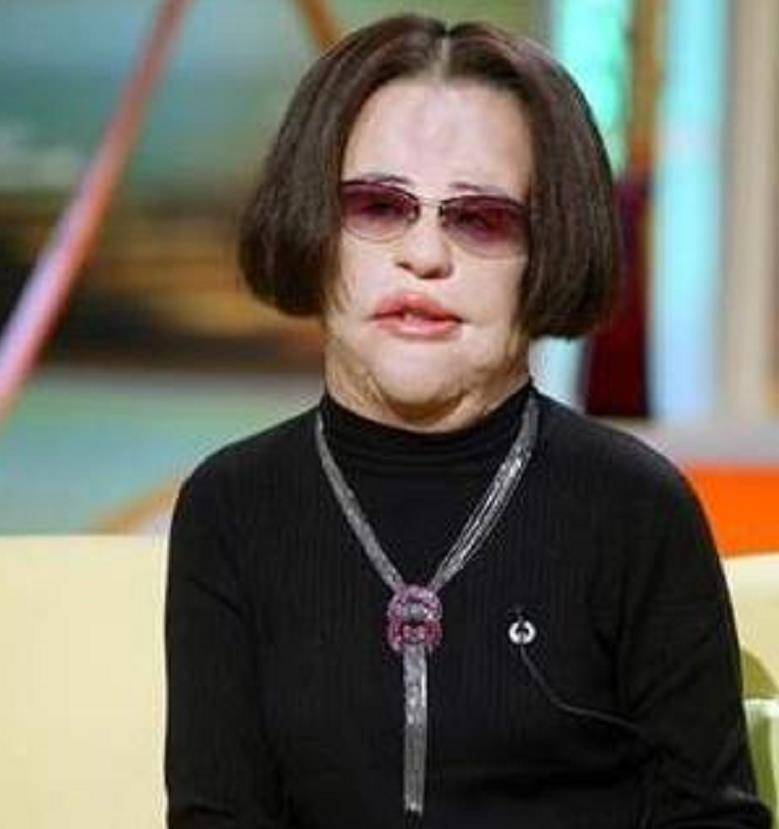 韩国女明星整容上瘾,自己向脸部注射食用油,9年无法闭眼睡觉