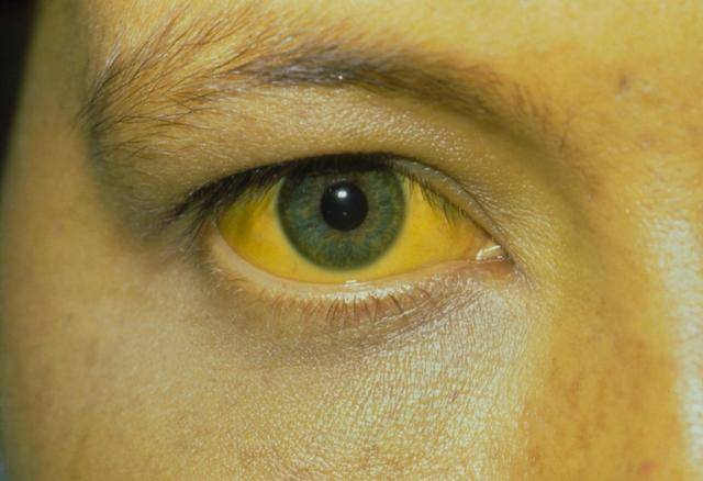 像急性乙肝,甲肝都会不程度的存在巩膜发黄,如果是角膜出现了色素环