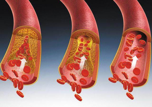 一盘菜,一杯茶,降血脂清血栓,三个月降到49%!