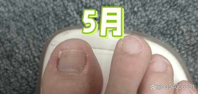 1-4月治好灰指甲经历(超详细)_真菌_时间_感觉