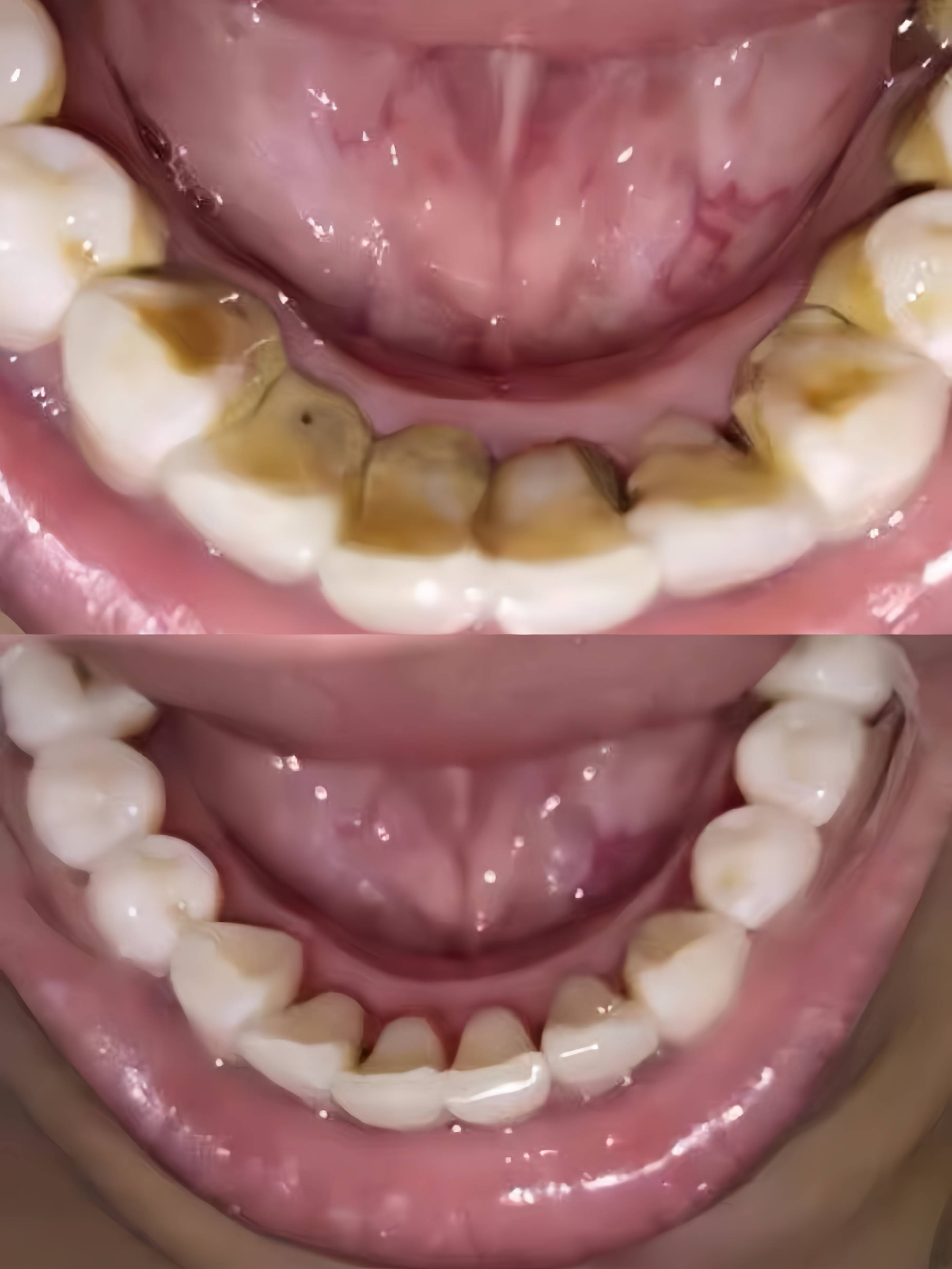 为什么天天刷牙还有牙结石和牙菌斑百科在线