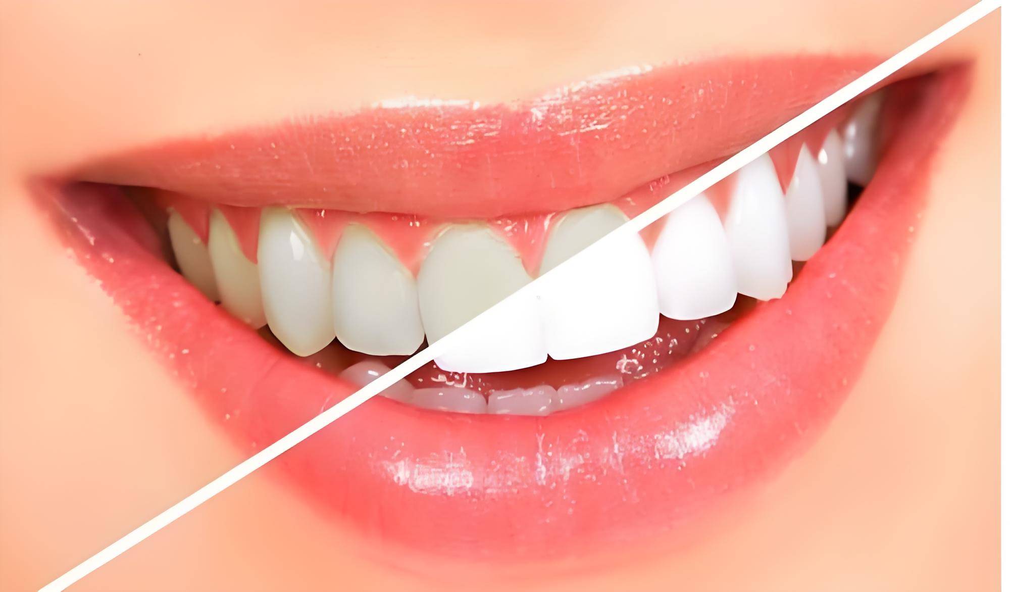 一口白牙就最健康吗?专家给出解答