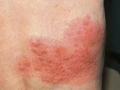 身体出现这3种症状,暗示带状疱疹要来了第一,在出疹的前几天前,身体