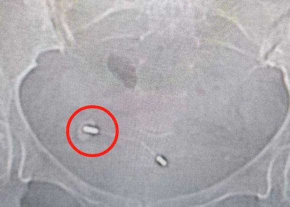 宫内节育环"离奇出逃",妈妈们要注意了!