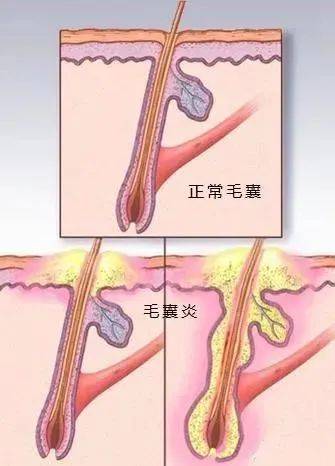 私处长了"痘痘,难道是得"那病"丨西安邱学华医院