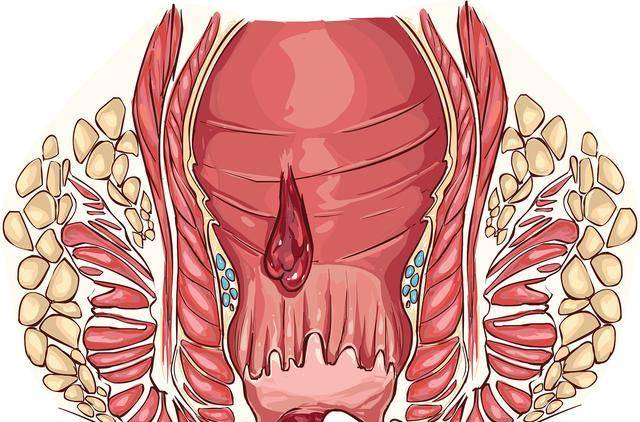 无论是男是女,经常感觉肛门处发痒,要留意