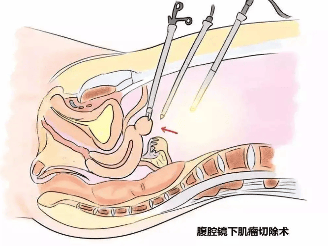 腹腔镜切子宫图片