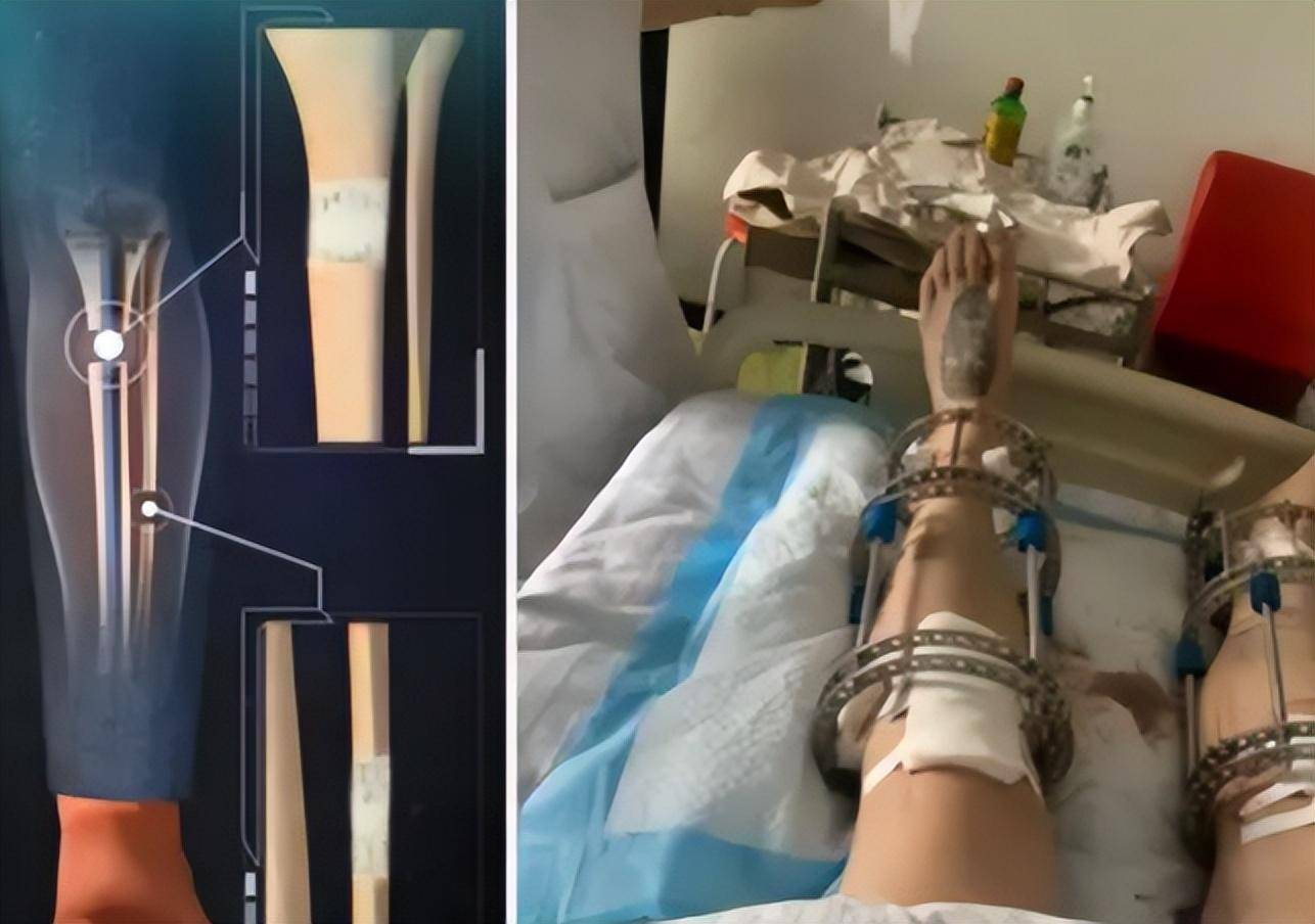 2厘米的李亚诺,如今和后