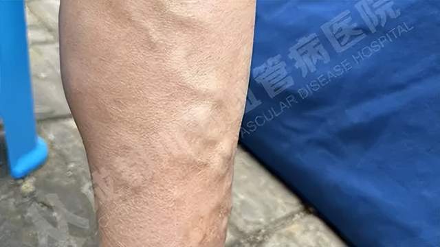 酸胀水肿" /p> p class="ql-align-center">"毛细血管扩张,青筋