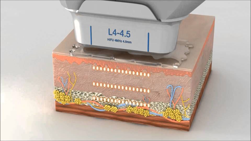 正确打开方式,做超声刀的好处和坏处,超声刀的功效作用及副作用!
