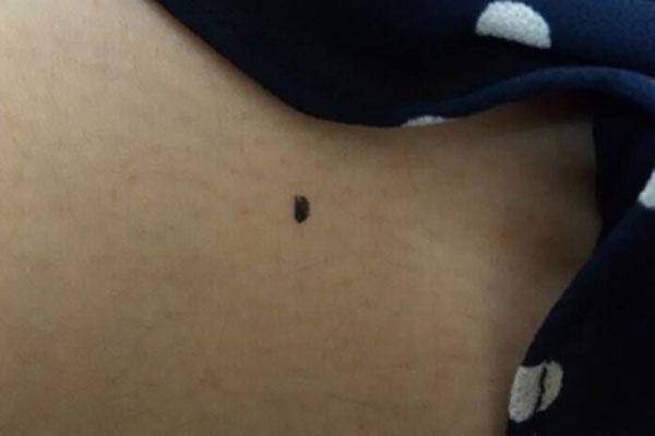 不对称痣可能是恶性的,因为黑色素瘤通常会导致痣的形状和颜色发生