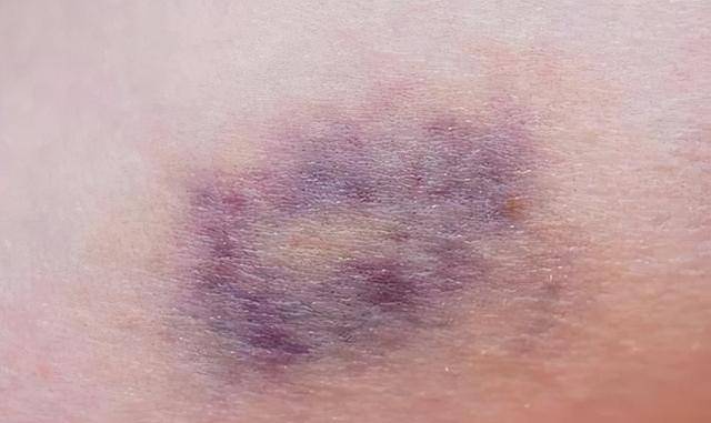 出现尸斑的原因并不是说尸体要尸变了,这是一种生物学现象.