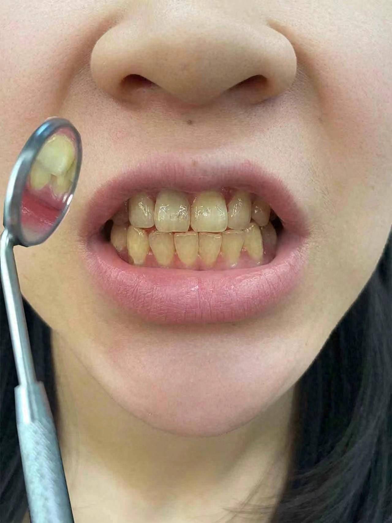 几十分钟就把牙结石给清除掉了不过过程可不好受水流不停地冲击牙龈