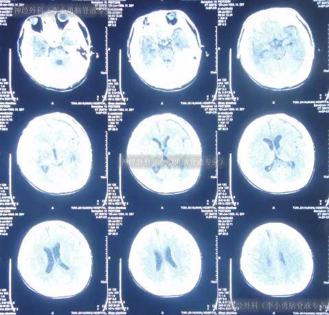 拔除腰大池引流后2天即2011年7月9日,查头部ct后认为无异常(图