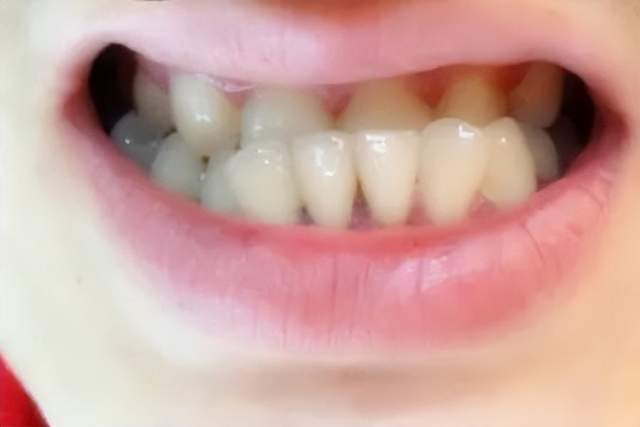 儿童牙齿出现哪些情况需要矫正？乳牙滞