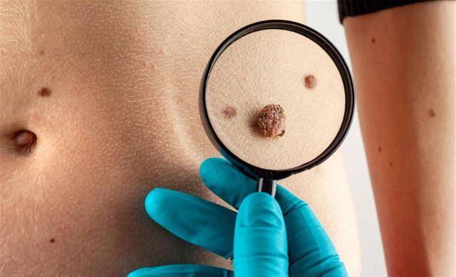 那些容易发生癌变的黑色痣可能短时间内体积变化速度快,会有增大的