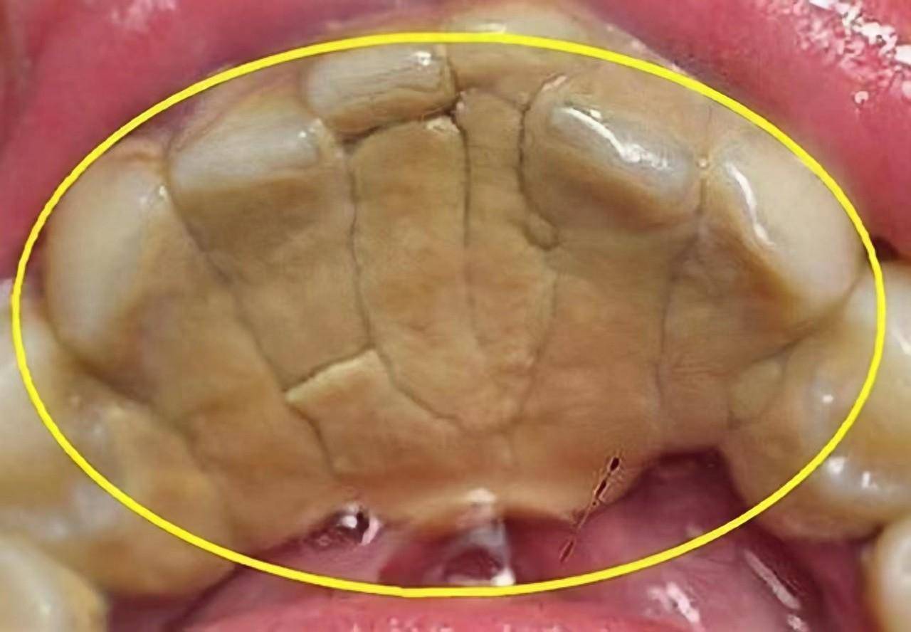 邢台资深种植专家:牙结石不痛不痒,有必要处理吗?
