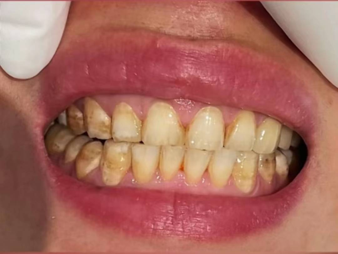 大黄牙,黑牙渍统统退退退!这个神器直接给我牙刷白了几个度!