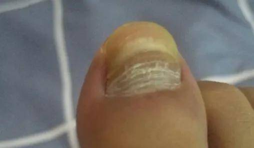 趾甲受伤后长出新趾甲变形,该如何应对?_文足_畸形_集团