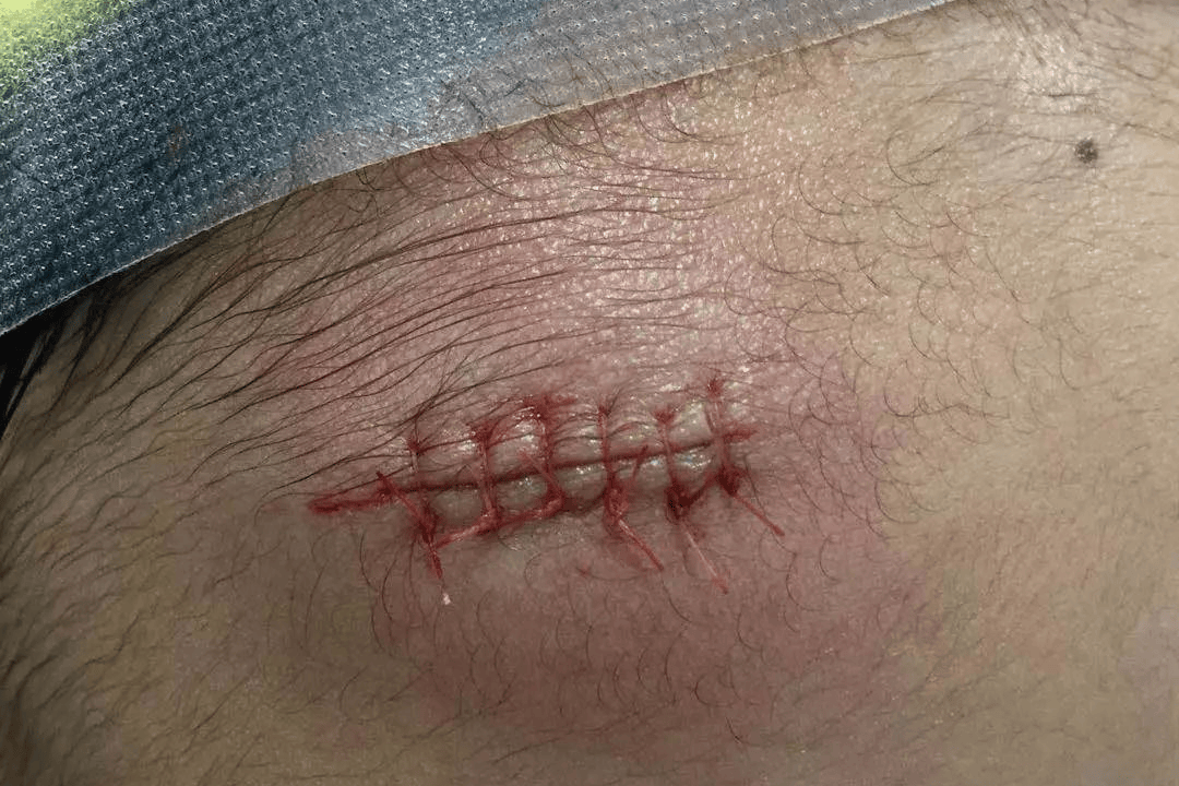 我儿子的疤痕修复记录