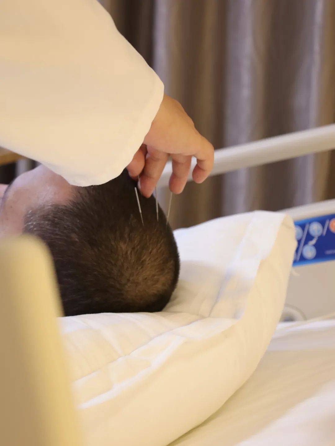 刺激穴位,能够有效缓解共济失调的症状;针灸四肢,疏通全身经络,调理