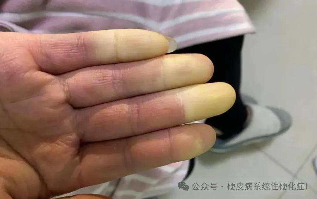 硬皮病早期,患者的主要症状是局部皮肤的轻度红