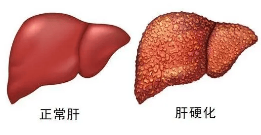 脂肪肝解剖图图片