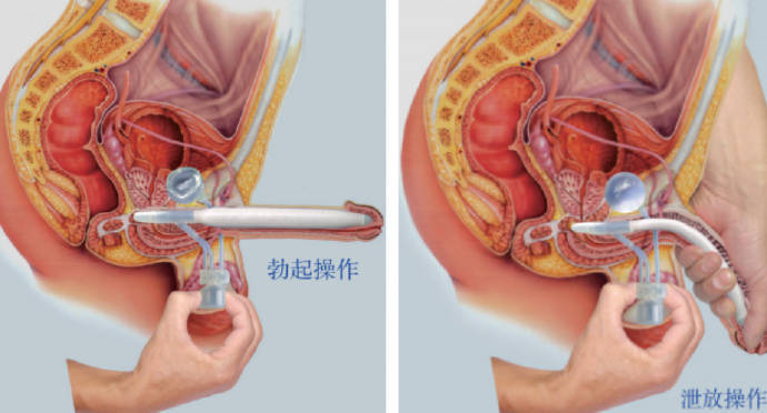 男科假体植入图片图片