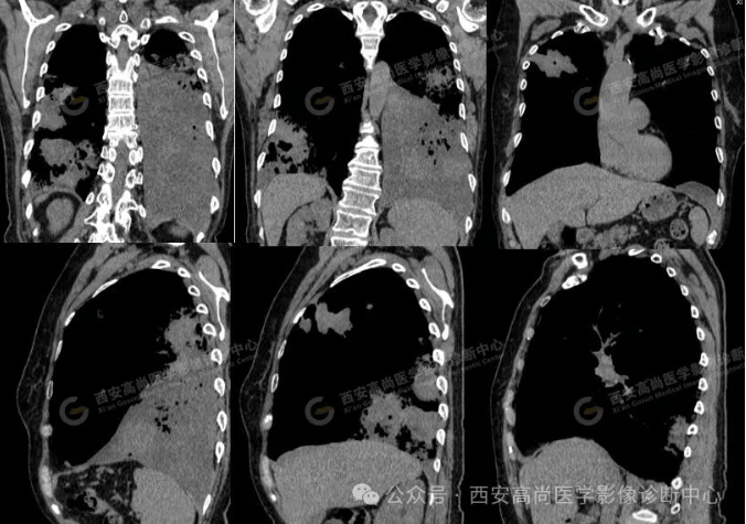 女,63岁,肺粘液腺癌一例