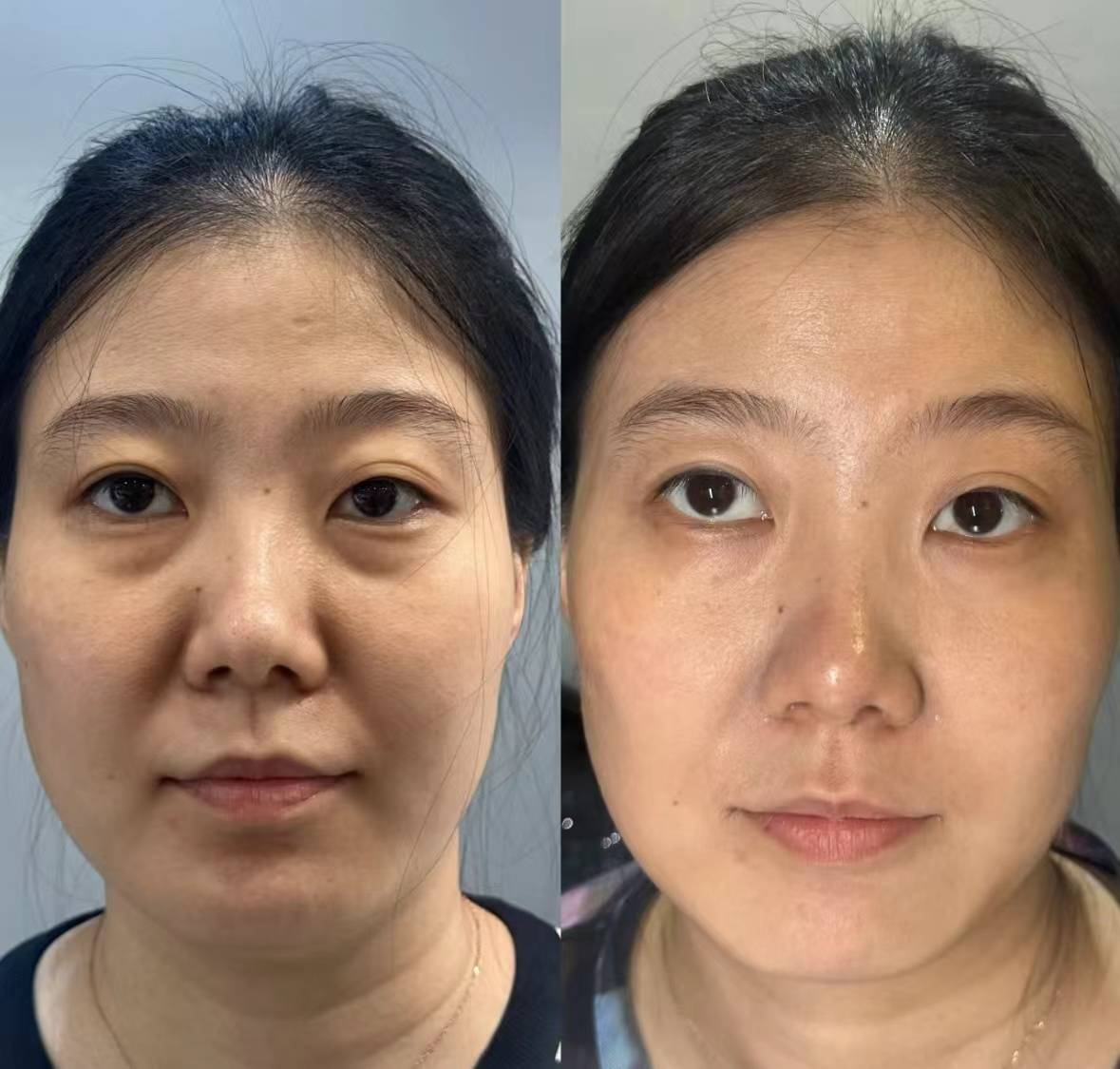 揭晓:抗皱产品哪个品牌好,亲测这款套装逆皱纹!