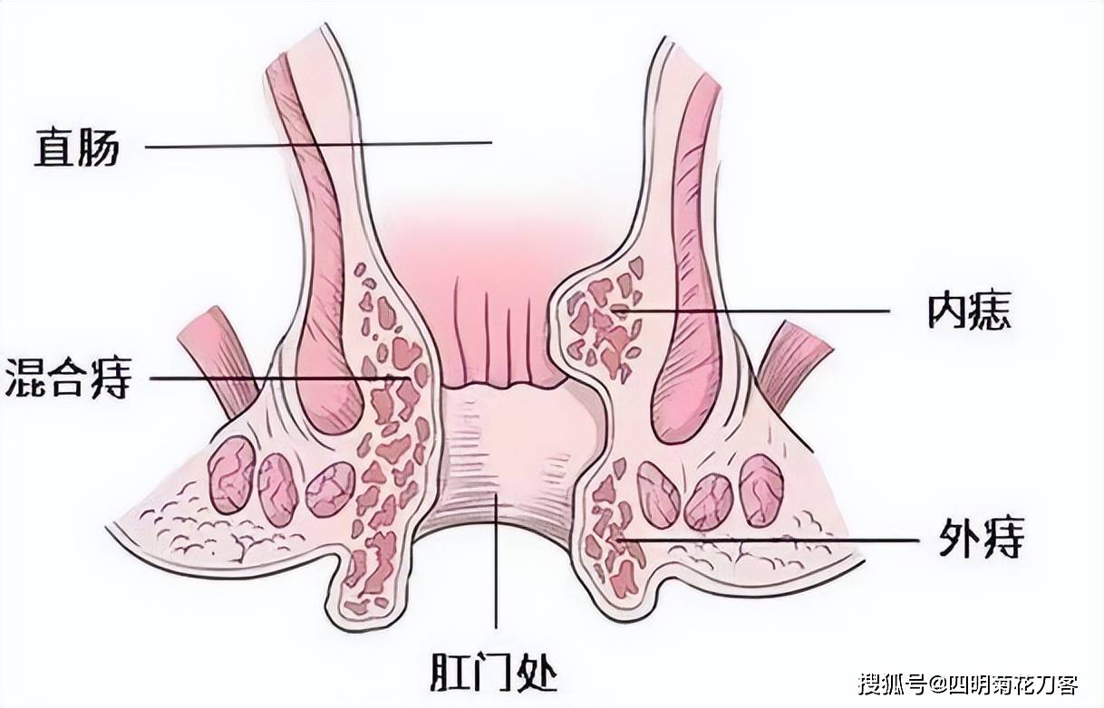 肛门边上长痣富贵图解图片