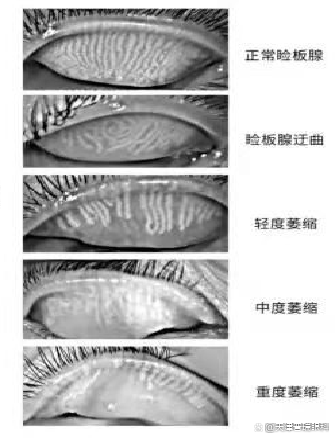 眼睑腺缺失图片