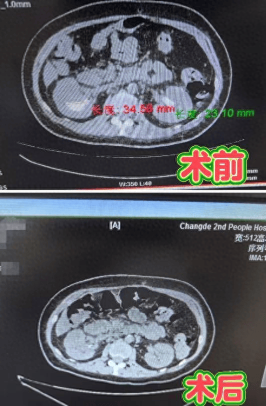 输尿管软镜截石位图片