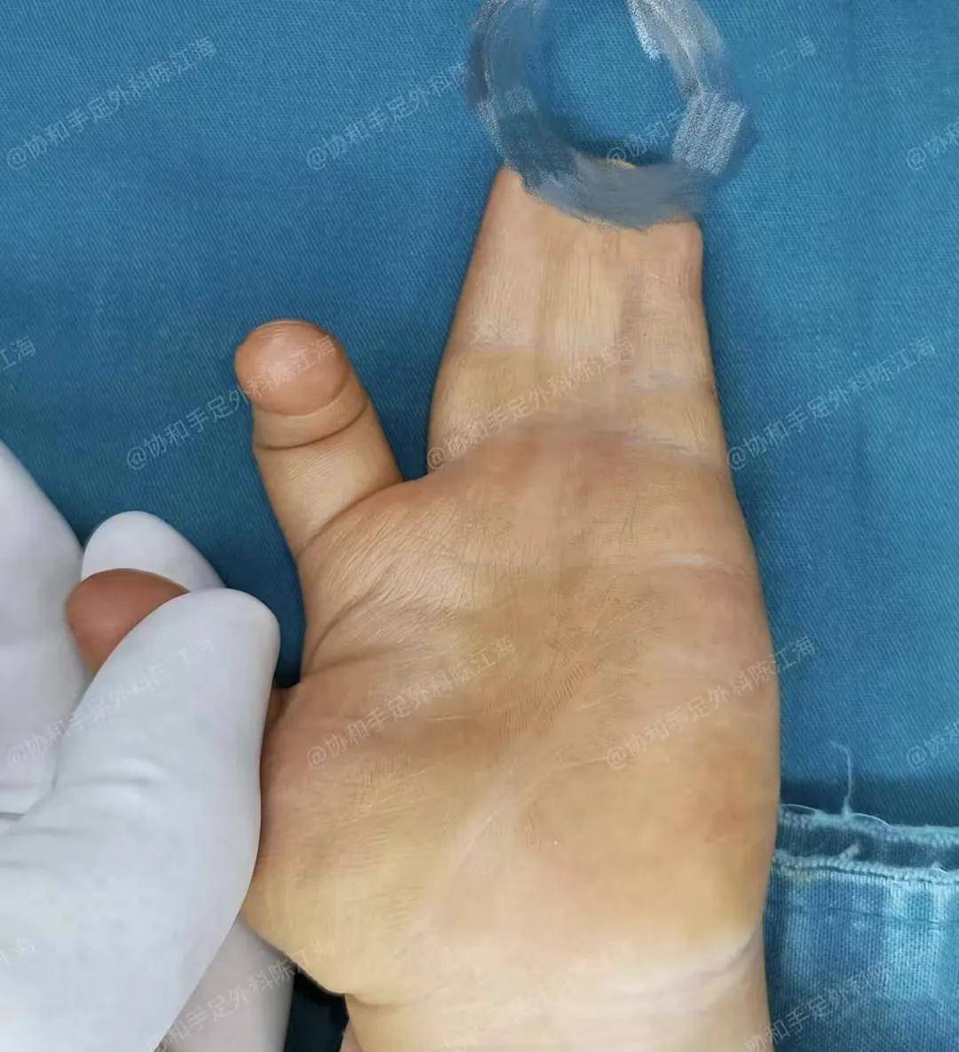 移植过去的皮肤一旦存活,恢复起来相对会更快.