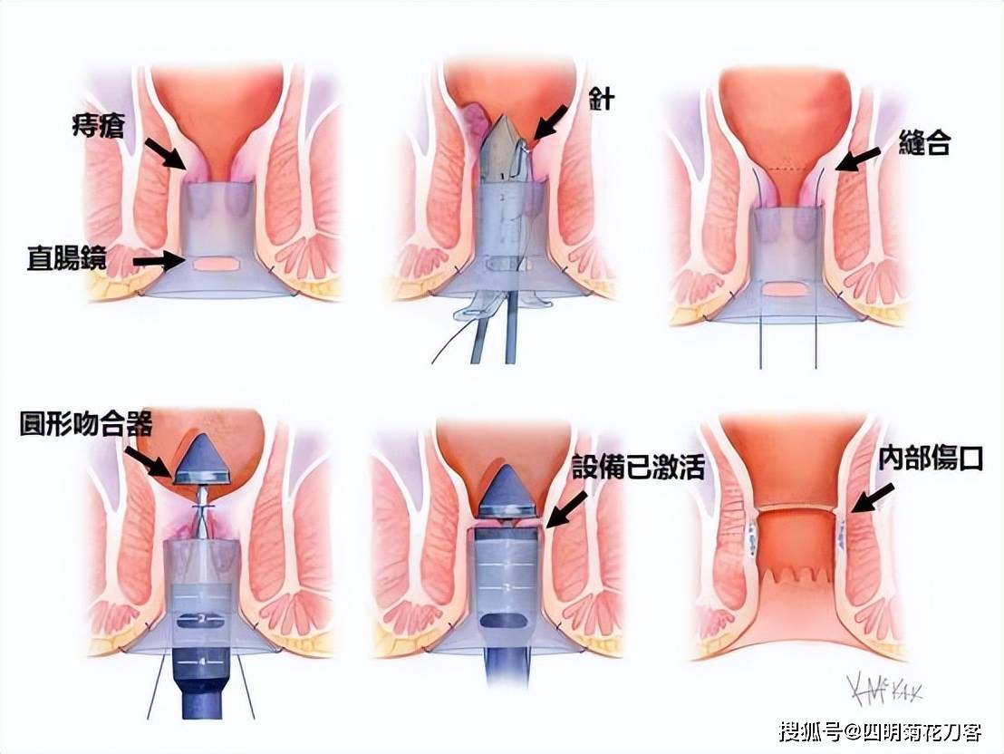 痔疮手术皮筋示意图图片