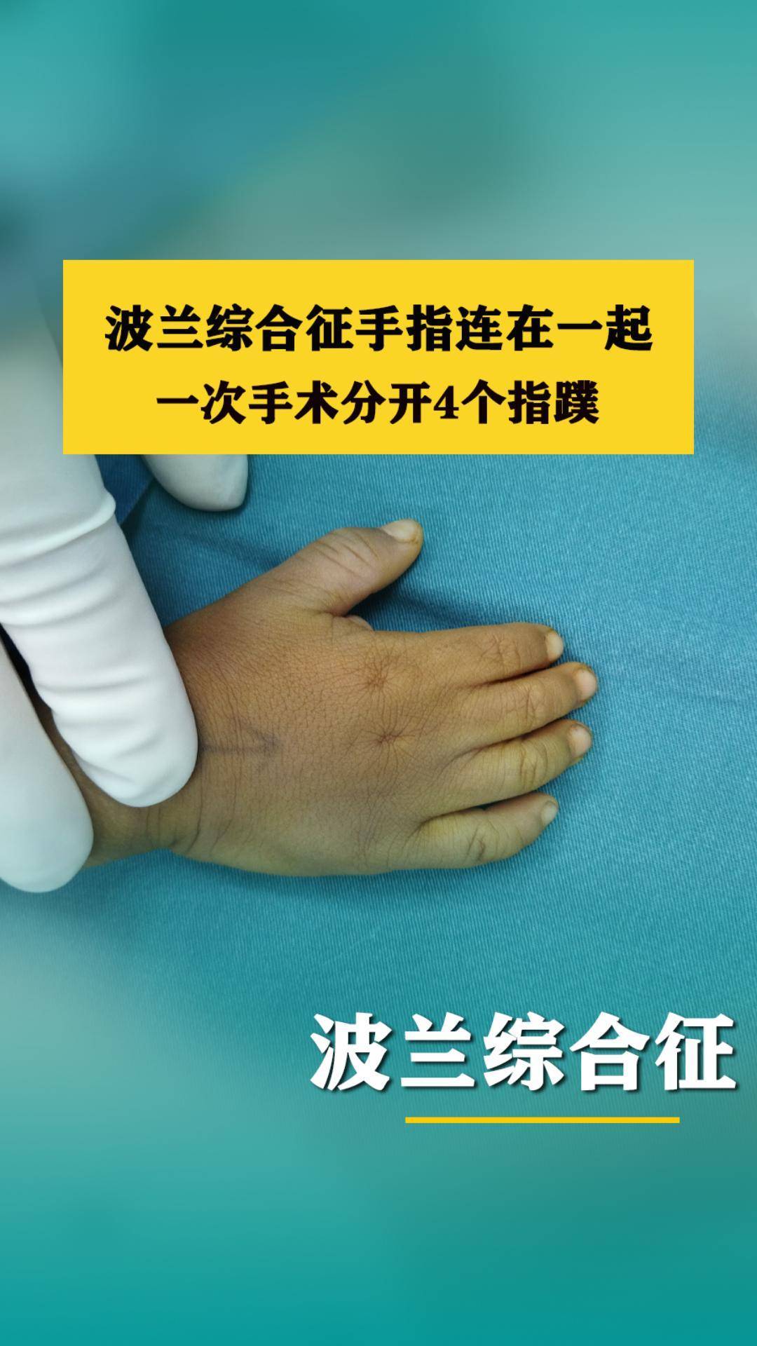 波兰综合征手指粘连在一起,一次手术分开4个指蹼