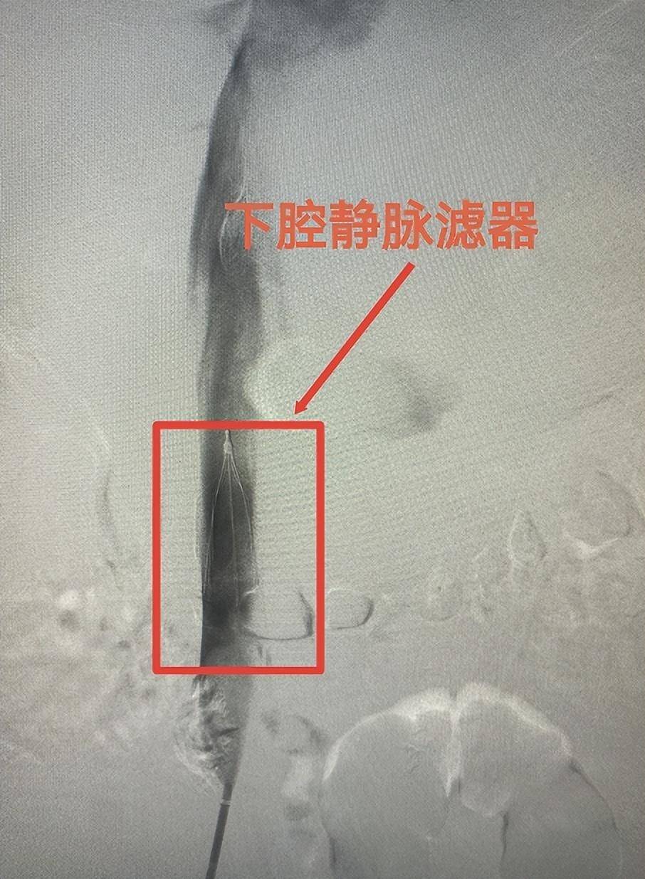 肺栓塞滤器图片