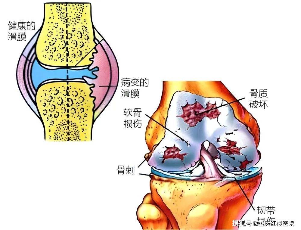 胫骨骨膜炎位置图片