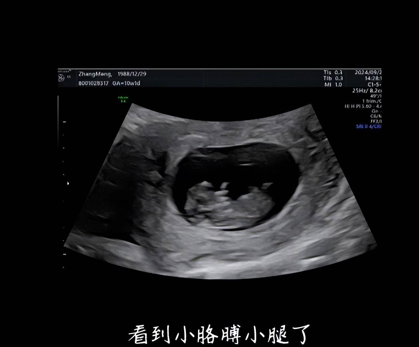 张檬去香港产检,b超看出是男孩,但脱鞋称体重时,拇外翻好明显