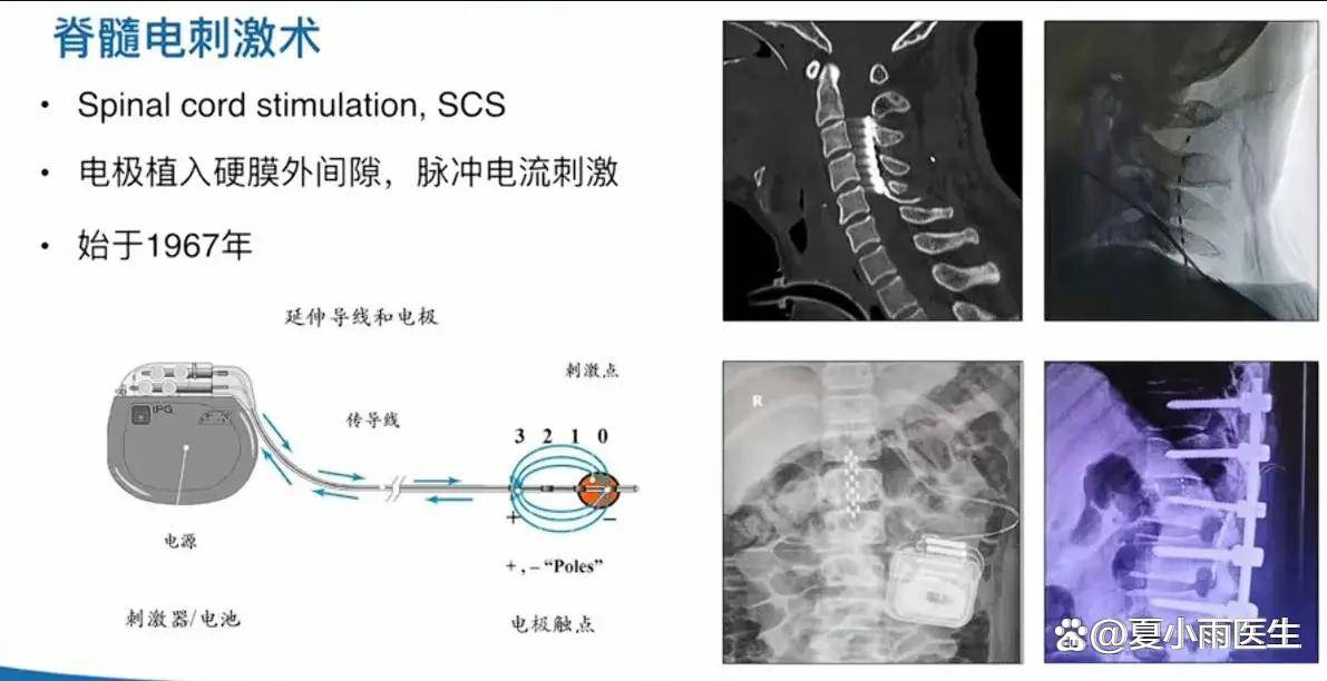 夏小雨医生:脊髓电刺激治疗脊髓损伤效果显著