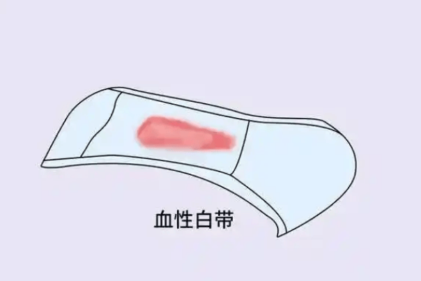 不规则的子宫出血,腹部胀大,下腹部可扪及块物,或者是出现大便不畅